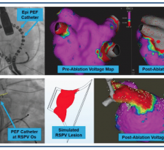 First-in-human Electroporation Ablation Study Finds Pulsed Electric Fields Can Target Specific Tissue For Atrial Fibrillation. #HRS2018 #HRS18
