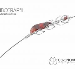 Cerenovus Launches Global Registry for EmboTrap II Revascularization Device