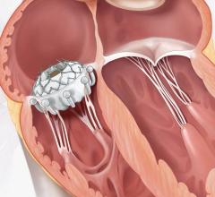 First FDA approved transcatheter therapy for patients with tricuspid regurgitation