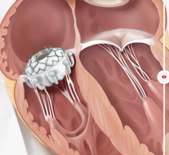 Edwards Lifesciences Corporation announced that one-year results on patients treated in the single-arm, prospective, global, multi-center TRISCEND study of the company's EVOQUE transcatheter tricuspid valve replacement system demonstrated favorable safety, efficacy and quality-of-life outcomes. 
