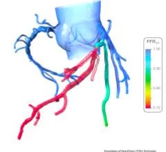 An example of HeartFlow's FFR-CT assessment, which shows areas of low blood flow based on computation fluid dynamics from a CT scan of the heart. The vendor's new PreRead software will use AI to clearly and reproducibly identify areas of ischemia due to coronary artery occlusion and act as a second set of eyes for emergency rooms evlautaing chest pain patients. 