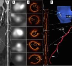 Image showing a co-registration of invasive coronary angiography (A), coronary CTA and straight MPR (panel B and C) with CTA cross sections (panel D), corresponding OCT cross sections and longitudinal OCT view (E).