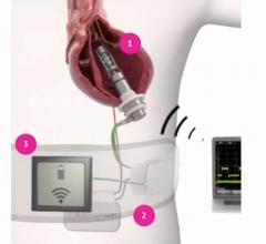 The FineHeart Transcutaneous Energy Transfer (TET) System for the ICOMS cardiac assist device. 1. The ICOMS heart pump. 2. The implanted TET transfer pad. 3. The external energy transfer pad.