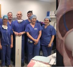 The heart team at St. James University Hospital Dublin was the first to perform a human implant of the CroiValve Duo Tricuspid Coaptation Valve technology for tricuspid repair.  