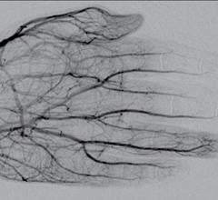DSA image obtained approximately 24 hours after 1 mg/h IA tPA infusion, 500 U/h heparin via peripheral IV, and daily oral aspirin (81 mg) shows improved perfusion of digital arteries, albeit with suboptimal vascular blush of distal second and third phalanges. Photo courtesy of ARRS
