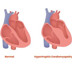 hypertrophic cardiomyopathy 