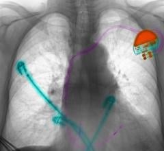 A heart-pacing lead is a small catheter with electrodes. 