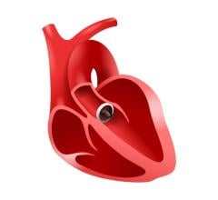 Patients who received the anticoagulant drug warfarin after bioprosthetic aortic valve replacement had lower incidence of mortality and a decreased risk of blood clots, according to a retrospective study published in Mayo Clinic Proceedings.