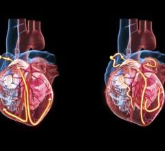 For men and women, the risk factors for cardiovascular disease are largely the same, an extensive global study involving University of Gothenburg researchers shows. 