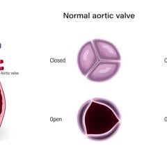 The diagnosed severity of aortic stenosis strongly correlates with clinical outcomes, new Kaiser Permanente research shows 