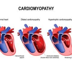 This is the first international guideline document to include all cardiomyopathy subtypes 