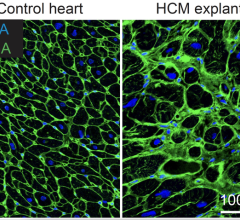 A microscopy picture of muscle cells in a normal heart (left) and muscle cells in a heart of a patient with hypertrophic cardiomyopathy (right). The black areas are single muscle cells. The muscle cells of the hypertrophic cardiomyopathy patient are bigger, and there is more space in between the cells (green), which is filled with scar tissues in the case of patients with hypertrophic cardiomyopathy. The blue indicates where the DNA of the cells can be found. Image courtesy of Anne de Leeuw, copyright Hubre