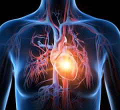 Heart attack, statins, 