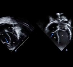 Left: Echocardiogram at birth shows severe non-delamination of the tricuspid valve septal leaflet, with coaptation point near the right ventricle apex (marked with arrow). The right ventricle is small, while the right atrium is large. Right: Jaxon’s echocardiogram today shows a normal tricuspid valve position (marked with arrow) and normal sizes of the right atrium and right ventricle. 
