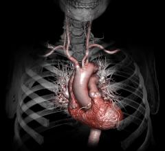 Carotid Artery MRI Improves Cardiovascular Disease Risk Assessment