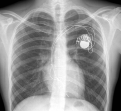 The new ACC Electrophysiology (EP) Device Implant Registry, part of the National Cardiovascular Data Registry (NCDR) will include data on implantable cardioverter defibrillator (ICD) and cardiac resynchronization therapy defibrillator (CRT-D) procedures previously captured in the NCDR ICD Registry, as well as provide the flexibility to capture novel pacemaker procedures. The registry is aligned with the ACC’s Electrophysiology Accreditation program, fully supporting the program’s data requirements.
