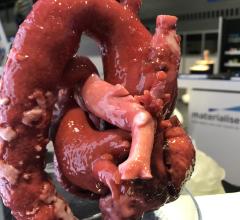 Example of life-like 3D printed cardiac and aortic anatomy available from Materialise. The vendor's software is FDA-cleared for use to print anatomy from CT or MRI studies that will be the exact size as the patient's actual anatomy. This can be used for planning and practicing complex surgical or interventional procedures and the model can aid navigation during procedures. 