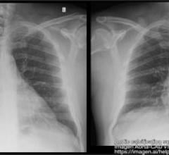 Designed to assist physicians detect findings on chest X-rays suggestive of Aortic Atherosclerosis and Aortic Ectasia.  