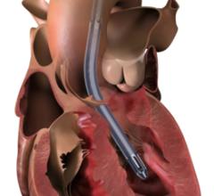 Abiomed (ABMD) announces the result of a three-year, investigator-led study of all Impella-supported patients treated at 109 hospitals in Japan shows a 30-day survival rate of 77% for patients with cardiogenic shock due to myocarditis. 