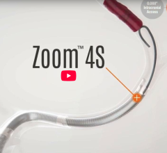 Imperative Care Introduces New Catheter