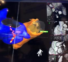 Imricor MRI-Guided Cardiac Ablation Study Results to Be Presented at HRS 2018