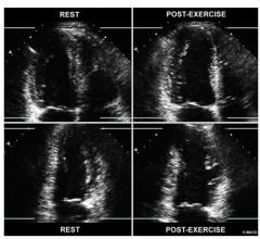 Figure 1 from the new ASE ischemia cardiac ultrasound imaging guidelines, showing a side-by-side views of apical 4- and 2-chamber images, at rest and immediately post-exercise. In the four-chamber view, the left ventricle is shown on the left-hand side of the screen. With exercise, the echocardiogram shows the LV cavity dilates (right quadrants) and there are regional wall motion abnormalities in the LAD territory. 