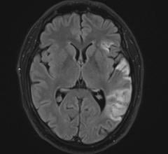 Researchers Develop Automated MRI System to Strengthen Stroke Treatment Studies