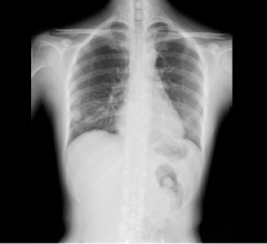 Researchers Publish Study on DDR-Based Technique for Assessing Heart Valve Regurgitation 