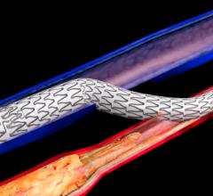 The LimFlow procedure permanently bypasses unreconstructable arteries and leverages healthier veins as a conduit to create new routes to perfuse tissue in the foot.  #VIVA #VIVA19 #VIVA2019