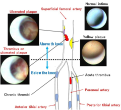 Angioscopic findings in the FPA and infrapopliteal lesions