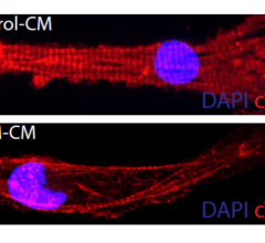 A heart muscle cell with mutations in the gene that makes the Rotatin protein (bottom) has disorganized muscle fibers (red) compared to healthy heart muscle cell (top).