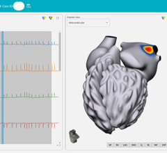 A new way of treating arrhythmias, including atrial fibrillation (AF) — the most common heart arrhythmia diagnosis in clinical practice — has debuted at UC San Diego Health. vMap is a non-invasive, computational mapping system that produces a three-dimensional, interactive map of arrhythmia hotspots anywhere in the heart, including all four chambers of the organ, the septal wall and the outflow tracts. 