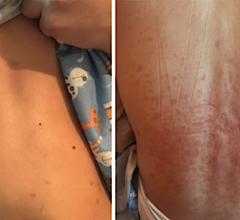 Exantham on abdomen and back of a pediatric patient at Nemours Children’s Health System in Delaware who presented with mysterious symptoms in what would later be identified as one of the first cases of multisystem inflammatory syndrome in children (MIS-C) in the United States.