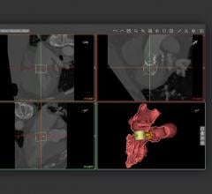 Materialise Receives FDA Clearance for Cardiovascular Planning Software Suite