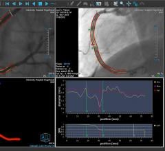 An example of the Medis QCA angiography imaging derived fractional flow reserve (FFR) assessment. This technology removes the need for pressure wires and adenosine used in traditional FFR assessments of the coronary arteries.