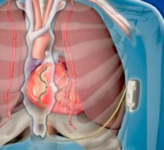 Medtronic Initiates Worldwide Pivotal Study of Extravascular Implantable Cardioverter Defibrillator