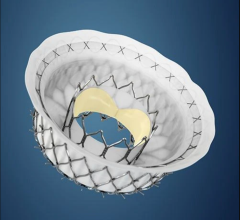 Medtronic Apollo Intrepid TMVR is currently in the middle of a U.S. clinical trial. #TCT #TCT21 #TMVR