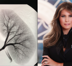 U.S. First Lady Melania Trump Undergoes Interventional Radiology Embolization Procedure