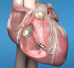 The Micra AV leadless pacemaker