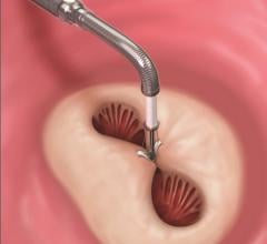 A MitraClip device being deployed to clasp together the leaflets of the mitral valve. This mimics a surgical suture repair to create a double orifice valve with better leaflet coaptation to prevent mitral regurgitation. Abbott Mitraclip device.