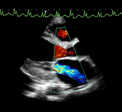 Mitral Valve regurgitation (MR) showed on an echocardiogram using a Toshiba system