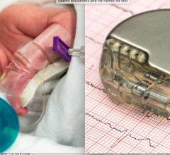 Neonates and young pediatric patients with congenital heart disease have few options for implantable electrophysiology (EP) devices like pacemakers or ICDs.