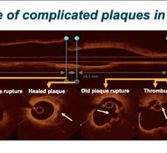 A longitudinal vessel assessment may demonstrate co-existence of multiple plaque morphologies on OCT, including superficial calcification with thrombus, healed plaque, plaque rupture, lipidic plaque with a thin capped fibrous atheroma (TCFA). #TCTconnect #TCT2020