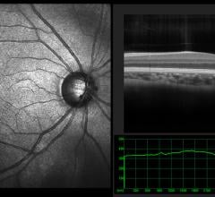 Ophthalmic optical coherence tomography (OCT) scan view of the macula in retina with vessels. Detecting heart disease with OCT imaging of the eye.Getty Images