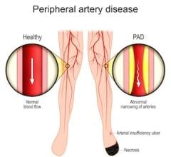 Study: Adherence to GDC Reduced Risk of Serious Limb Events at Two Years