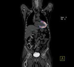 New PET-CT Scan Improves Detection in Rare Cardiac Condition