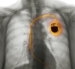 Pacemaker, Afib, ai
