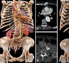 Comparison of image quality between EID CT with standard contrast media protocol and PCD CT with low-volume contrast media protocol using a matched radiation dose. Transverse and three-dimensional cinematic rendered images from thoracoabdominal CTA in a 71-year-old woman in group 2 are shown. (A–C) Images from third-generation EID CT with automated tube voltage selection of 90 kVp. (D–F) Images from PCD CT with reduced contrast media volume of 52.5 mL and VMI at 50 keV. Time interval between scans was 6 mon