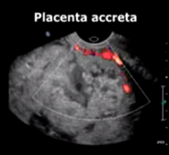 interventional radiology, placenta accreta, RSNA, study