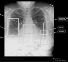 chest, x-ray, reporting, Qure.ai,